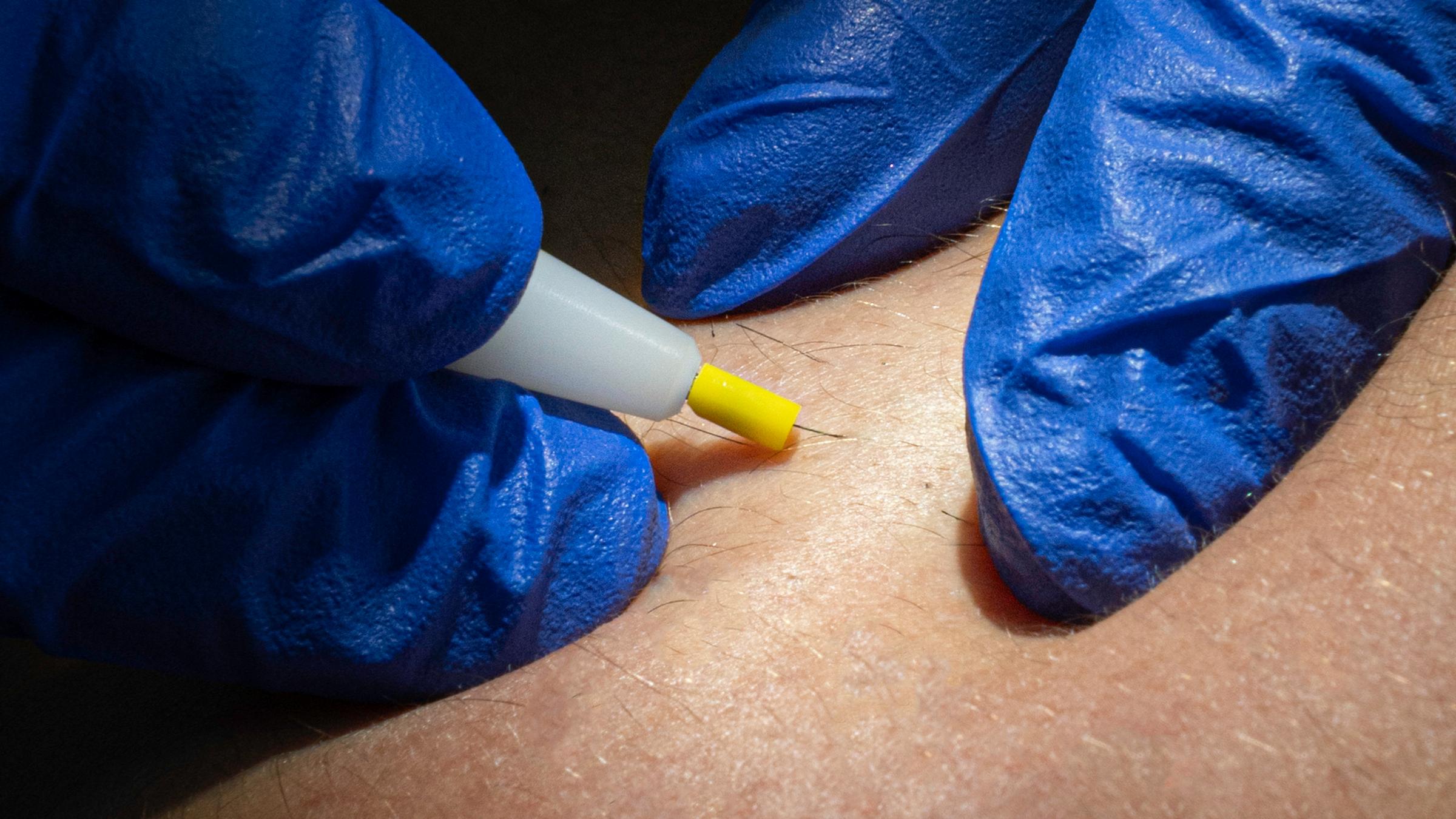 The only method recognized as truly permanent