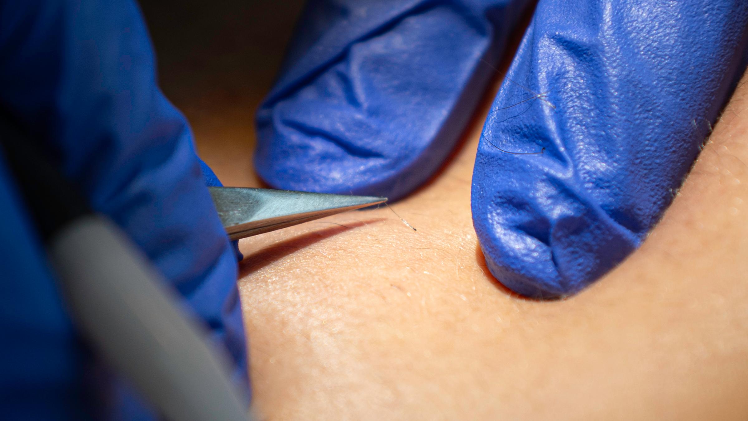 Removing a hair with tweezers